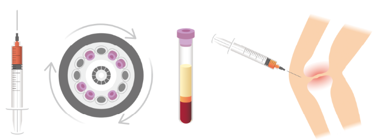 LC-PRP療法とは?のイメージ